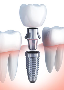 Implant dentaire : un implant performant ?