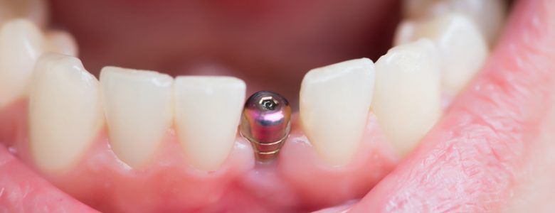 Implant dentaire Lyon : comment faire le choix du meilleur cabinet ?